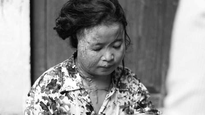 Moung Sreymom, the victim of an acid attack in Phnom Penh, Cambodia on November 19, 2014.
